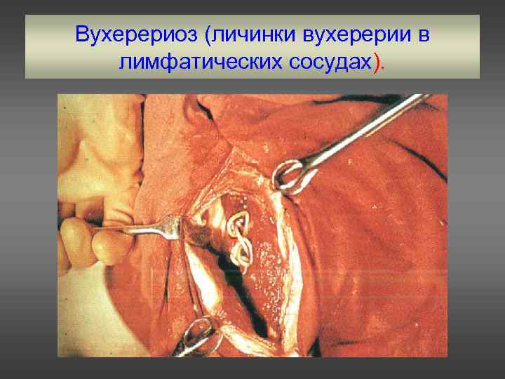 Вухерериоз (личинки вухерерии в лимфатических сосудах). 