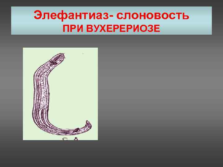 Элефантиаз- слоновость ПРИ ВУХЕРЕРИОЗЕ 