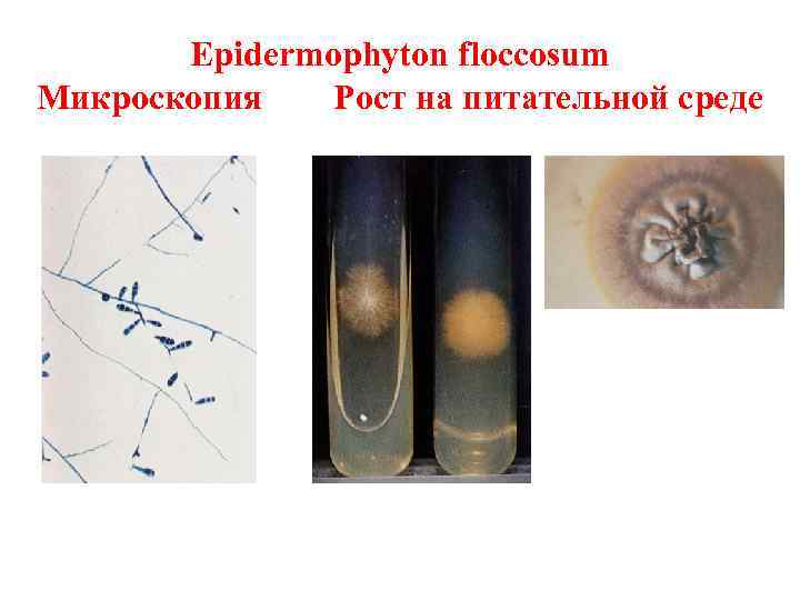 Epidermophyton floccosum Микроскопия Рост на питательной среде 