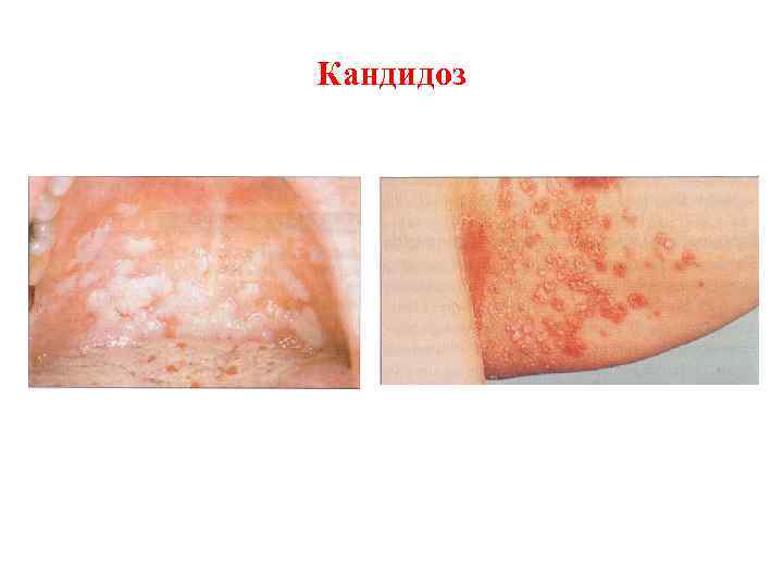 Кандидоз 