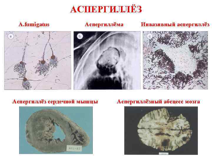АСПЕРГИЛЛЁЗ A. fumigatus Аспергиллёма Аспергиллёз сердечной мышцы Инвазивный аспергиллёз Аспергиллёзный абсцесс мозга 