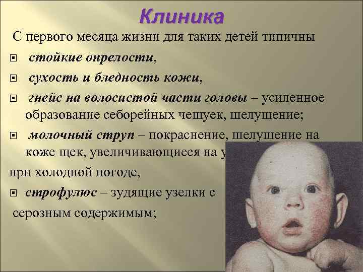     Клиника С первого месяца жизни для таких детей типичны 