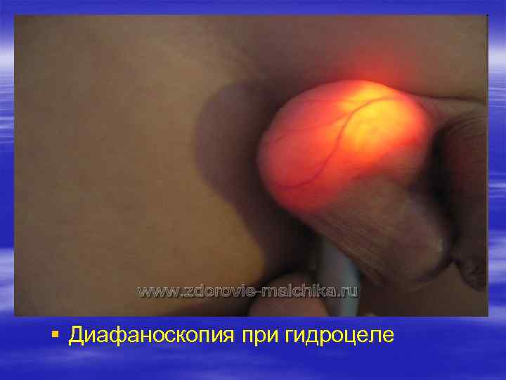 § Диафаноскопия при гидроцеле 