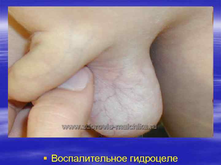 § Воспалительное гидроцеле 