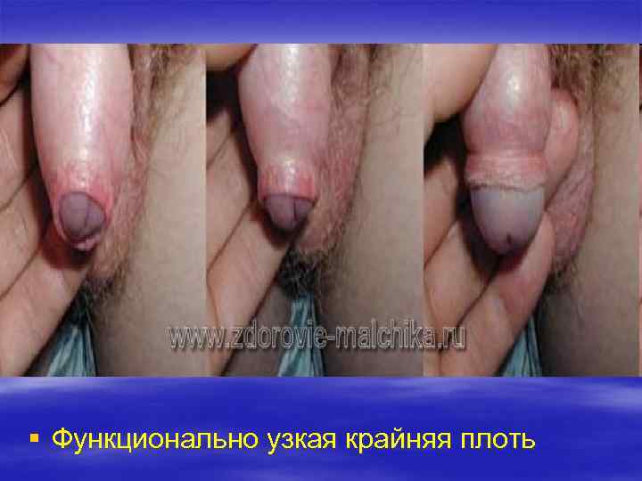§ Функционально узкая крайняя плоть 