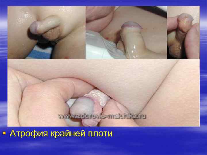 § Атрофия крайней плоти 