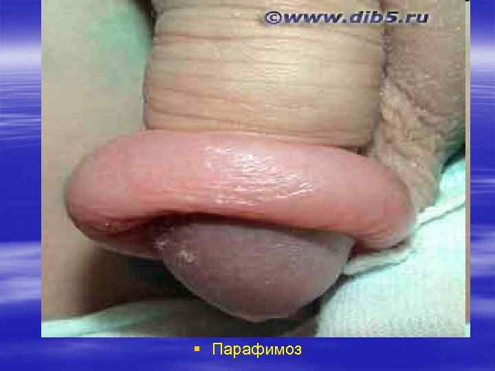 § Парафимоз 
