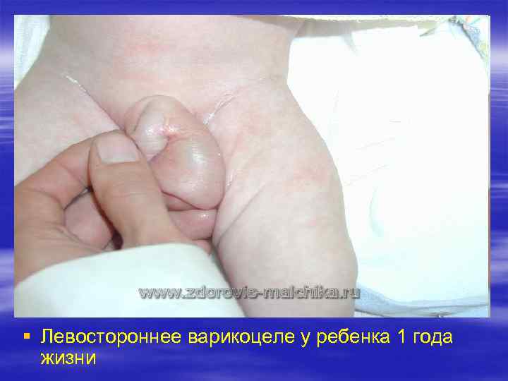 § Левостороннее варикоцеле у ребенка 1 года  жизни 