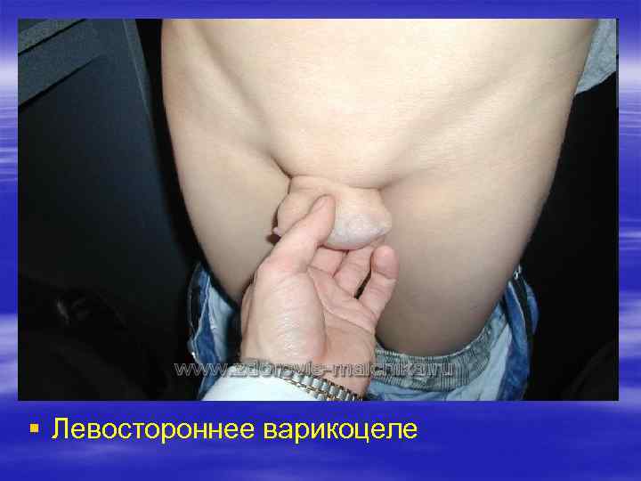 § Левостороннее варикоцеле 