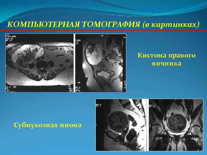 КОМПЬЮТЕРНАЯ ТОМОГРАФИЯ (в картинках) Кистома правого КОМПЬЮТЕРНАЯ ТОМОГРАФИЯ (в картинках) Кистома правого