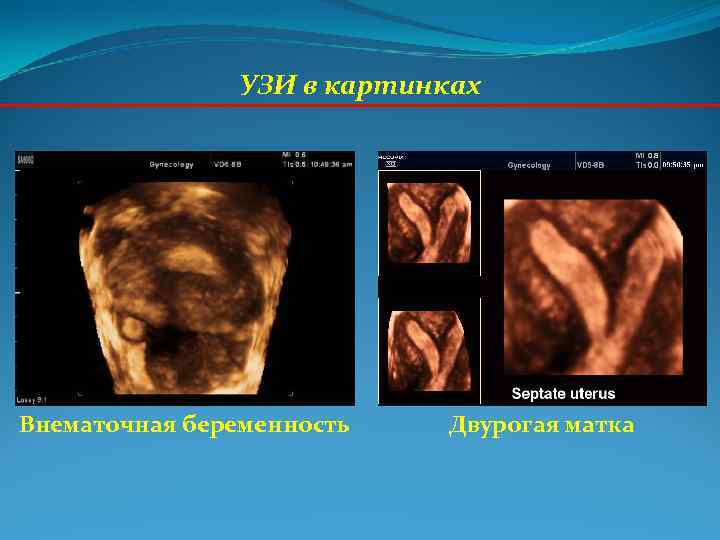 УЗИ в картинках Внематочная беременность Двурогая матка УЗИ в картинках Внематочная беременность Двурогая матка