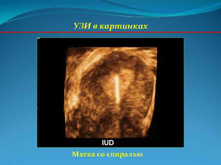 УЗИ в картинках Матка со спиралью УЗИ в картинках Матка со спиралью