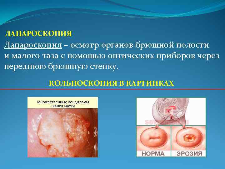 ЛАПАРОСКОПИЯ Лапароскопия – осмотр органов брюшной полости и малого таза с помощью оптических приборов ЛАПАРОСКОПИЯ Лапароскопия – осмотр органов брюшной полости и малого таза с помощью оптических приборов