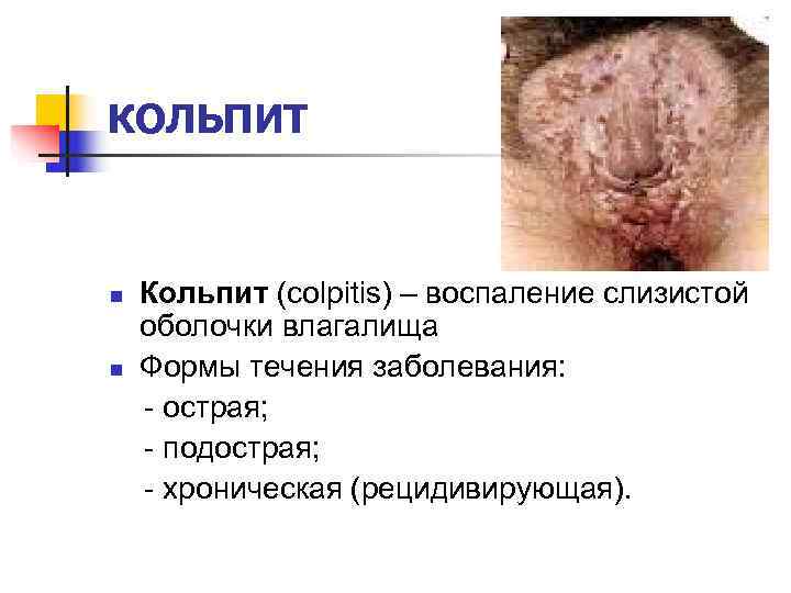 КОЛЬПИТ  n  Кольпит (colpitis) – воспаление слизистой оболочки влагалища n  Формы