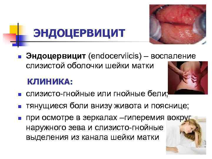  ЭНДОЦЕРВИЦИТ n  Эндоцервицит (endocerviicis) – воспаление слизистой оболочки шейки матки КЛИНИКА: n