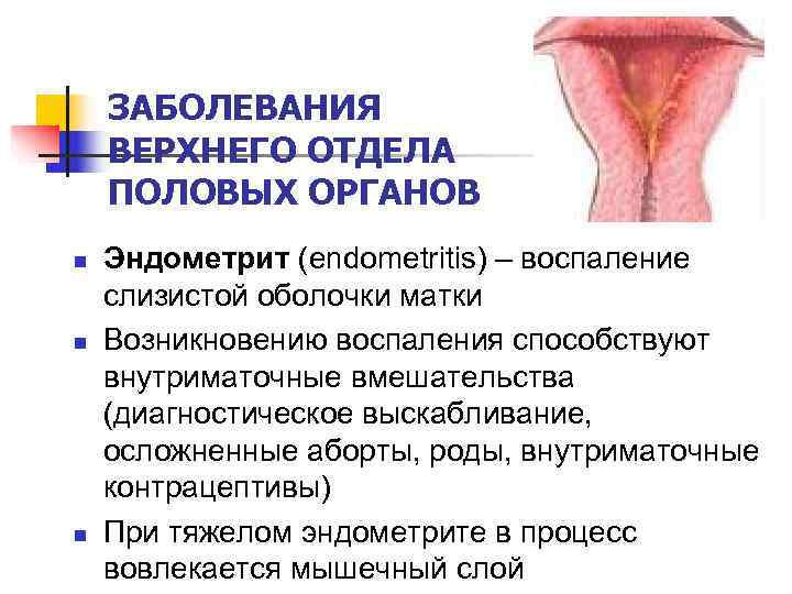  ЗАБОЛЕВАНИЯ ВЕРХНЕГО ОТДЕЛА ПОЛОВЫХ ОРГАНОВ n  Эндометрит (endometritis) – воспаление слизистой