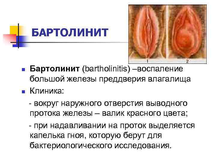   БАРТОЛИНИТ  n  Бартолинит (bartholinitis) –воспаление большой железы преддверия влагалища n