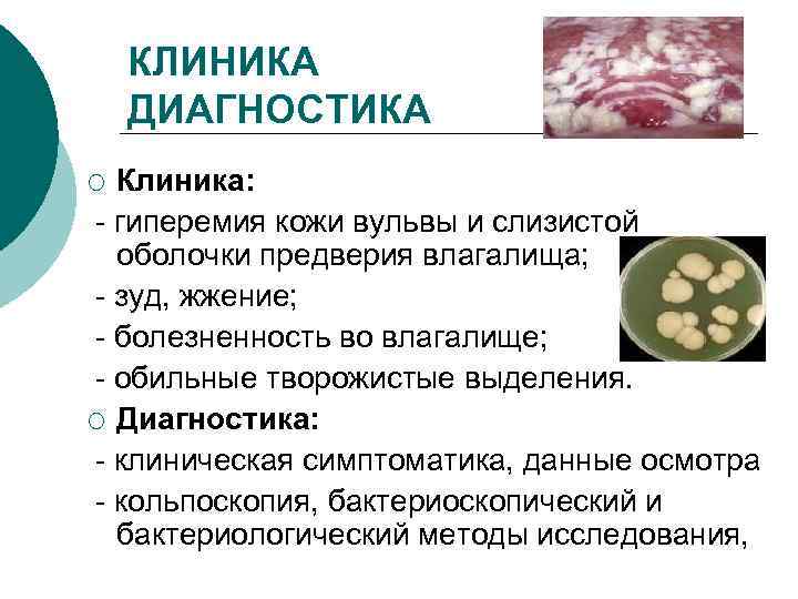   КЛИНИКА ДИАГНОСТИКА ¡ Клиника: - гиперемия кожи вульвы и слизистой  оболочки