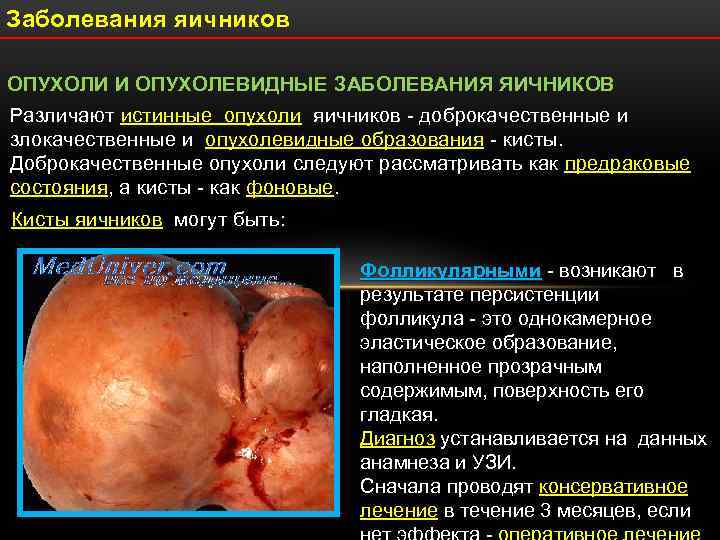 Заболевания яичников ОПУХОЛИ И ОПУХОЛЕВИДНЫЕ ЗАБОЛЕВАНИЯ ЯИЧНИКОВ Различают истинные опухоли яичников - доброкачественные и