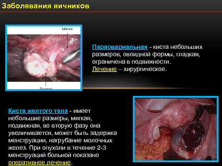 Заболевания яичников      Параовариальная - киста небольших   