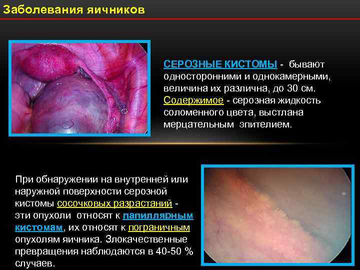 Заболевания яичников       СЕРОЗНЫЕ КИСТОМЫ - бывают  