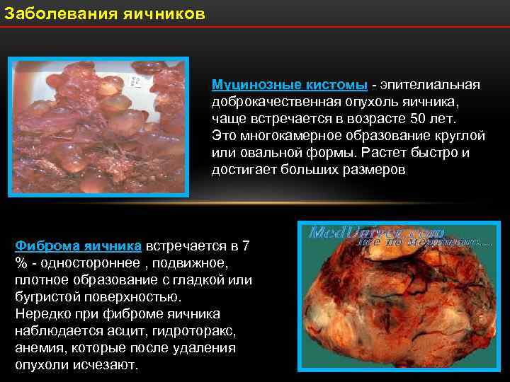 Заболевания яичников      Муцинозные кистомы - эпителиальная   