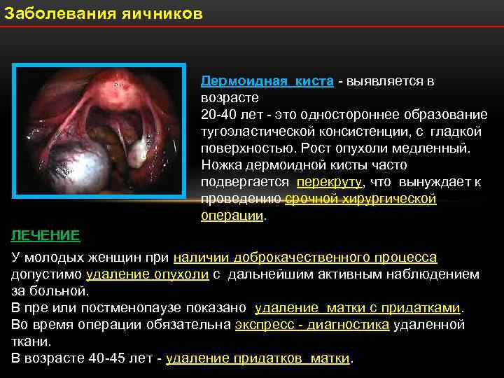 Заболевания яичников      Дермоидная киста - выявляется в  