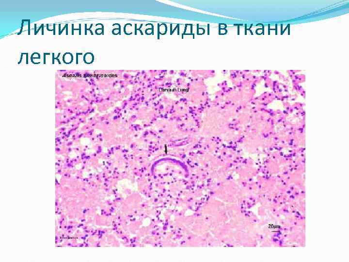 Личинка аскариды в ткани легкого Личинка аскариды в ткани легкого