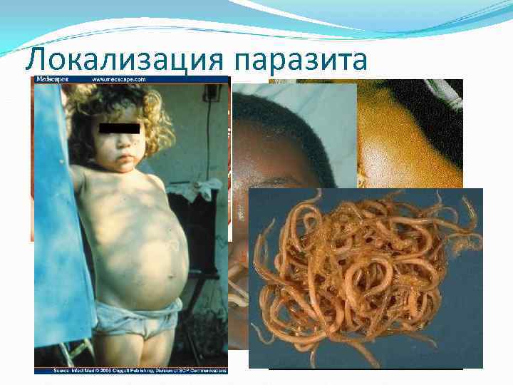 Локализация паразита Локализация паразита