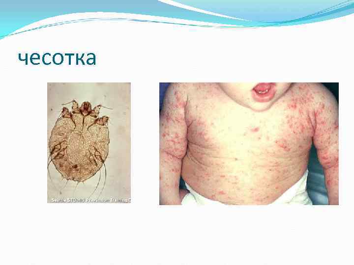 чесотка чесотка