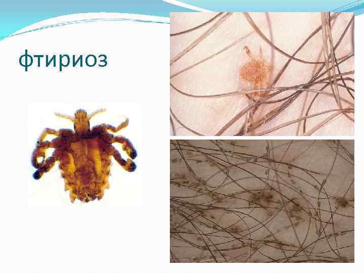 фтириоз фтириоз