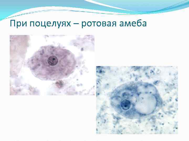При поцелуях – ротовая амеба При поцелуях – ротовая амеба