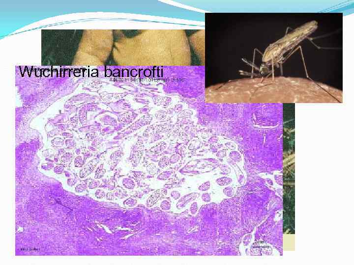Wuchirreria bancrofti Wuchirreria bancrofti
