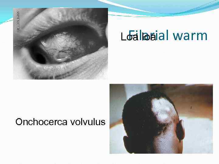 Filarial Loa loa warm Onchocerca volvulus Filarial Loa loa warm Onchocerca volvulus