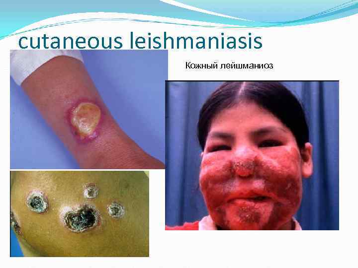cutaneous leishmaniasis Кожный лейшманиоз cutaneous leishmaniasis Кожный лейшманиоз
