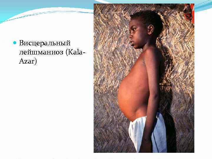 Висцеральный лейшманиоз (Kala- Azar) Висцеральный лейшманиоз (Kala- Azar)