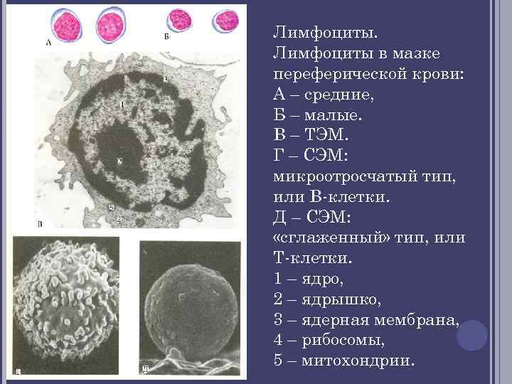 Лимфоциты в мазке переферической крови: А – средние, Б – малые. В – ТЭМ.
