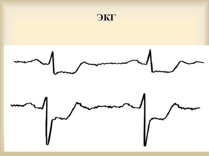   ЭКГ      1/22/2018   22 