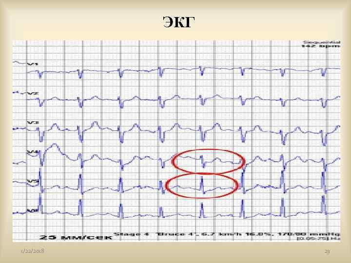   ЭКГ      1/22/2018   23 