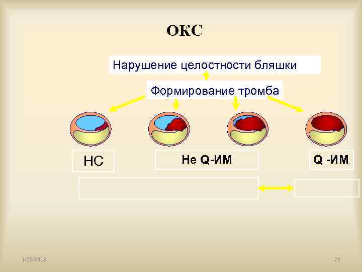      ОКС    Нарушение целостности бляшки  