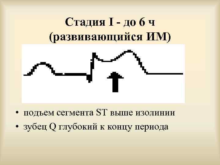    Стадия I - до 6 ч  (развивающийся ИМ) • подъем