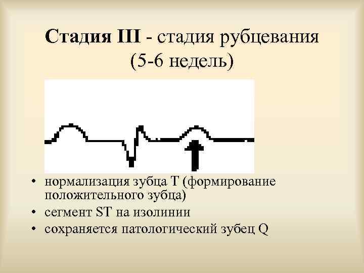  Стадия III - стадия рубцевания   (5 -6 недель) • нормализация зубца