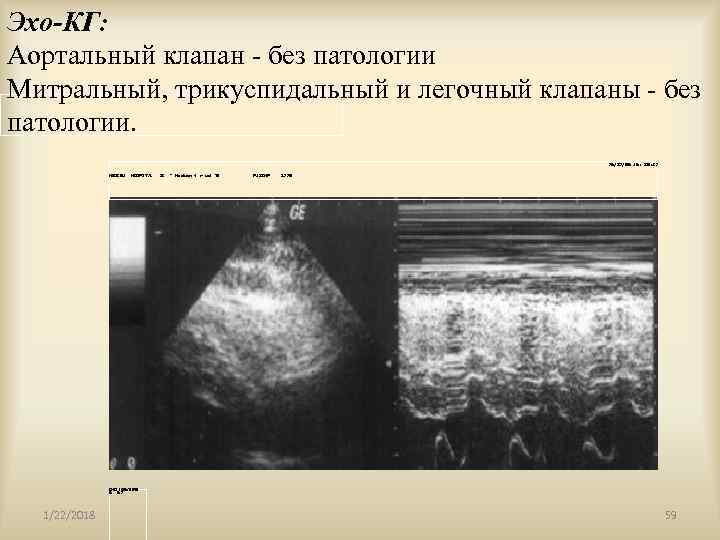 Эхо-КГ: Аортальный клапан - без патологии Митральный, трикуспидальный и легочный клапаны - без патологии.