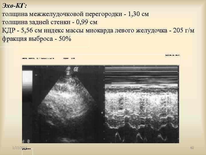Эхо-КГ: толщина межжелудочковой перегородки - 1, 30 см толщина задней стенки - 0, 99