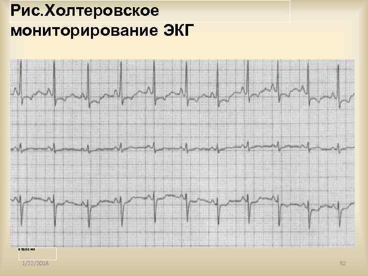 Рис. Холтеровское мониторирование ЭКГ 6: 50: 00 AM 1/22/2018  62 
