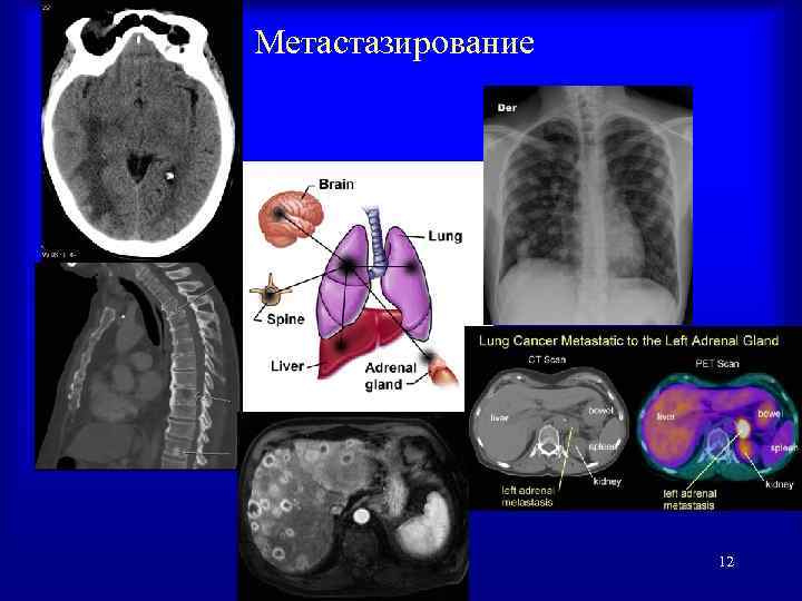 Метастазирование 12 