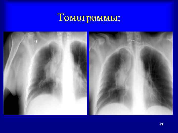 Томограммы: 29 