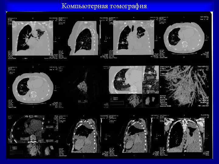 Компьютерная томография 43 