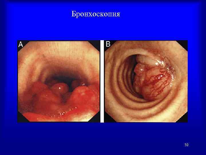 Бронхоскопия 50 