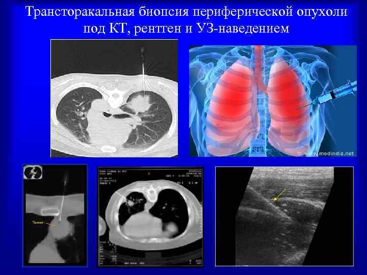Биопсия легких. Трансторакальная пункция легких. Пункция легкого под контролем кт. Трансторакальная пункционная биопсия легких. Трансторакальная пункция опухоли легкого.